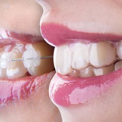 Teeth Aligners vs. Clear Braces Showdown: Which is Better?
