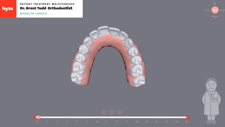 Invisalign Braces Before and After Review [VIDEO]