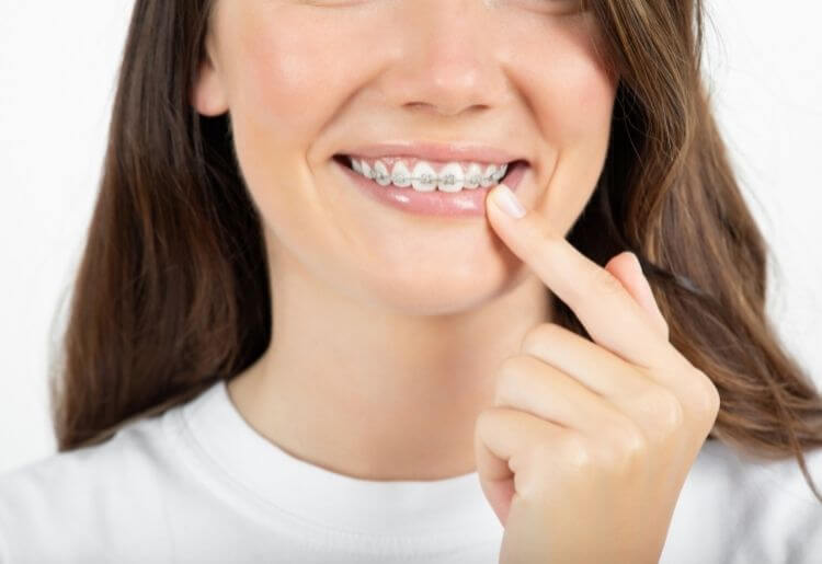 How to Keep Clear Braces Bands From Turning Yellow